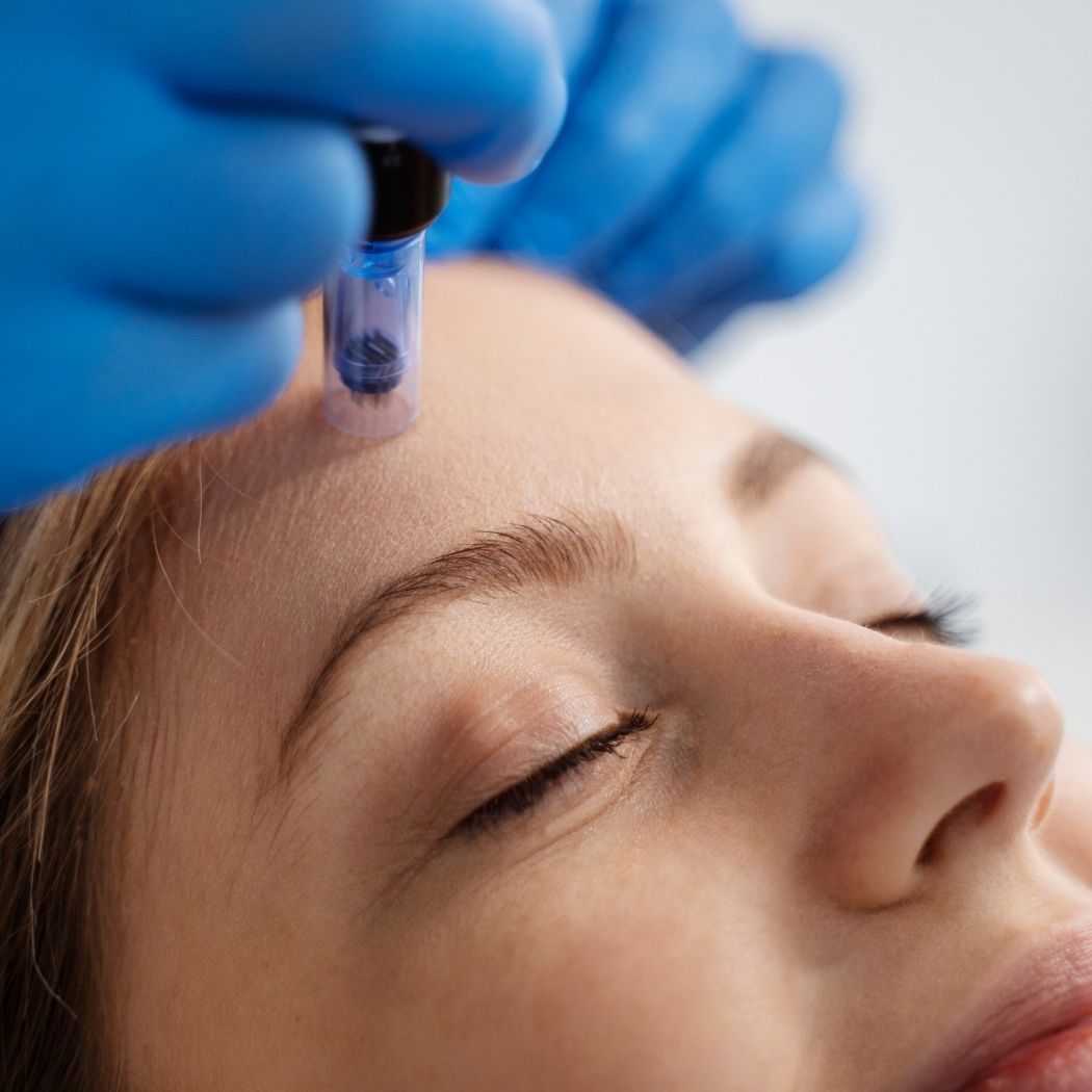 Microneedling bei Glamskin: die Stirn einer Kundin wird mit einem Microneedling-Gerät behandelt.